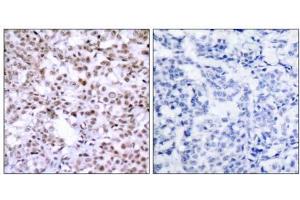 Immunohistochemical analysis of paraffin-embedded human breast carcinoma tissue using Chk2 (Ab-68) antibody (E021087). (CHEK2 anticorps)