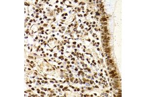 Immunohistochemistry of paraffin-embedded human gastric cancer using XRCC4 Antibody. (XRCC4 anticorps)