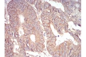 Immunohistochemical analysis of paraffin-embedded rectum cancer tissues using 1-193 mouse mAb with DAB staining. (alpha Adducin anticorps  (AA 1-193))