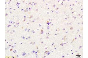 Formalin-fixed and paraffin embedded human glioma labeled with Anti-MIF Polyclonal Antibody, Unconjugated  at 1:200 followed by conjugation to the secondary antibody and DAB staining. (MIF anticorps  (AA 51-115))