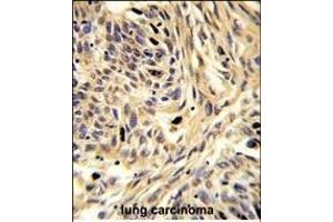 Formalin-fixed and paraffin-embedded human lung carcinoma reacted with HSPD1 Antibody (C-term), which was peroxidase-conjugated to the secondary antibody, followed by DAB staining.