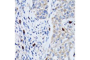 Immunohistochemistry of paraffin-embedded human lung cancer using MAP1LC3B antibody. (LC3B anticorps)