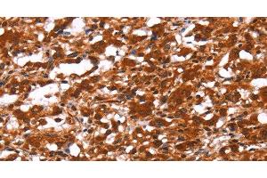 Immunohistochemistry of paraffin-embedded Human thyroid cancer using FUT1 Polyclonal Antibody at dilution of 1:30 (FUT1 anticorps)