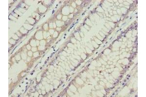 Immunohistochemistry of paraffin-embedded human colon cancer using ABIN7153839 at dilution of 1:100 (GCSAML anticorps  (AA 1-135))