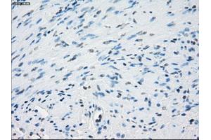 Immunohistochemical staining of paraffin-embedded Adenocarcinoma of colon tissue using anti-AURKCmouse monoclonal antibody. (Aurora Kinase C anticorps)