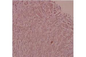 Immunohistochemistry analysis of ADM Antibody in paraffin-embedded human breast carcinoma tissue at 1/100. (Adrenomedullin anticorps)