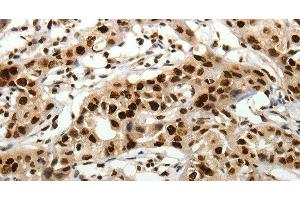 Immunohistochemistry of paraffin-embedded Human lung cancer tissue using SCN1A Polyclonal Antibody at dilution 1:40 (SCN1A anticorps)