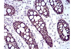 Immunohistochemical analysis of paraffin-embedded colon tissues using CDH17 mouse mAb with DAB staining.
