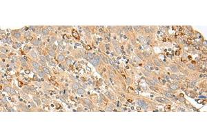 Immunohistochemistry of paraffin-embedded Human cervical cancer tissue using SLC5A1 Polyclonal Antibody at dilution of 1:80(x200) (SLC5A1 anticorps)