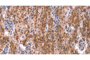 Immunohistochemistry of paraffin-embedded Human gastric cancer using GH1 Polyclonal Antibody at dilution of 1:40 (Growth Hormone 1 anticorps)