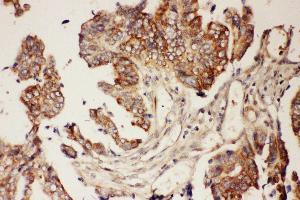 Anti-CNTF Picoband antibody,  IHC(P): Human Intestinal Cancer Tissue