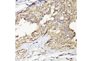 Immunohistochemistry of paraffin-embedded human breast cancer using T Rabbit pAb (ABIN6129486, ABIN6148851, ABIN6148852 and ABIN6223435) at dilution of 1:200 (40x lens). (TARBP2 anticorps  (AA 1-366))