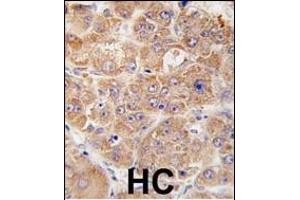 Formalin-fixed and paraffin-embedded human hepatocarcinoma tissue reacted with hUVRAG (N-term ), which was peroxidase-conjugated to the secondary antibody, followed by DAB staining. (UVRAG anticorps  (AA 120-152))