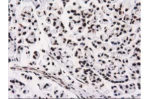 Immunohistochemical staining of paraffin-embedded Adenocarcinoma of Human colon tissue using anti-ATP6V1F mouse monoclonal antibody. (ATP6V1F anticorps)