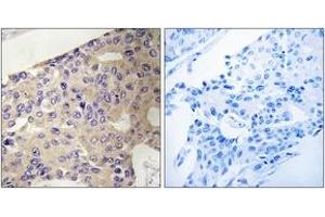 Immunohistochemistry analysis of paraffin-embedded human breast carcinoma tissue, using PEX10 Antibody. (PEX10 anticorps  (AA 183-232))