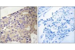 Immunohistochemistry analysis of paraffin-embedded human breast carcinoma tissue, using PEX10 Antibody.