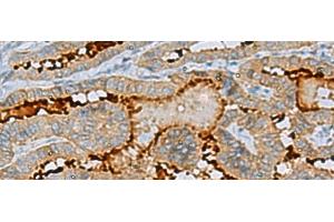 Immunohistochemistry of paraffin-embedded Human thyroid cancer tissue using ENKD1 Polyclonal Antibody at dilution of 1:75(x200) (ENKD1 anticorps)