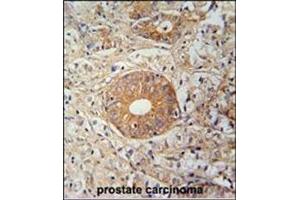 Immunohistochemistry analysis in Formalin Fixed, Paraffin Embedded Human prostate carcinoma stained with SLC35E2 Antibody (N-term) followed by peroxidase conjugation of the secondary antibody and DAB staining. (SLC35E2 anticorps  (N-Term))