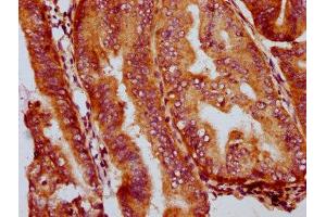 IHC image of ABIN7153647 diluted at 1:400 and staining in paraffin-embedded human endometrial cancer performed on a Leica BondTM system.