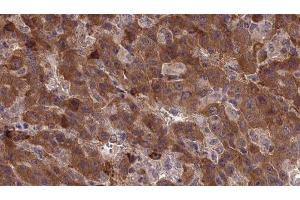 ABIN6277338 at 1/100 staining Human liver cancer tissue by IHC-P. (CDH23 anticorps  (N-Term))