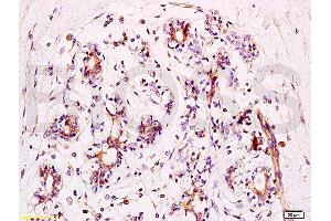 Formalin-fixed and human breast carcinoma tissue labeled with Anti-phospho-BACH1/BRIP1(Ser990) Polyclonal Antibody, Unconjugated  at 1:200 followed by conjugation to the secondary antibody and DAB staining