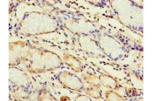 Immunohistochemistry of paraffin-embedded human gastric cancer using ABIN7172261 at dilution of 1:100 (TLR1 anticorps  (AA 25-580))