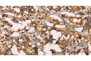 Immunohistochemistry of paraffin-embedded Human thyroid cancer using SENP1 Polyclonal Antibody at dilution of 1:40 (SENP1 anticorps)