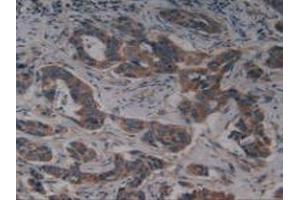 IHC-P analysis of Human Breast Cancer Tissue, with DAB staining. (KIT anticorps  (AA 321-520))