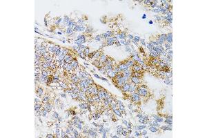 Immunohistochemistry of paraffin-embedded human gastric cancer using PDYN antibody. (PDYN anticorps)