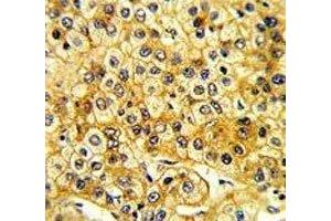 IHC analysis of FFPE human hepatocarcinoma with Src antibody