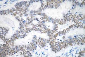 Immunohistochemistry was performed on paraffin-embedded human sigmoid colon carcinoma using SOX9 antibody (ABIN7800973), 1:200). (Recombinant SRY-Box Transcription Factor 9 anticorps)