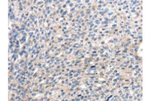 The image on the left is immunohistochemistry of paraffin-embedded Human breast cancer tissue using ABIN7127958(CENPM Antibody) at dilution 1/30, on the right is treated with fusion protein. (CENPM anticorps)