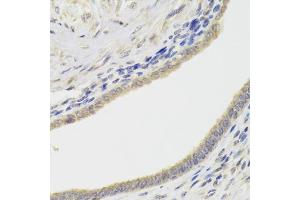 Immunohistochemistry of paraffin-embedded human adenomyosis using HDAC4 Antibody (ABIN5975864) at dilution of 1/100 (40x lens). (HDAC4 anticorps)