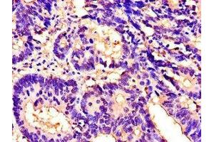 Immunohistochemistry of paraffin-embedded human colon cancer using ABIN7156464 at dilution of 1:100