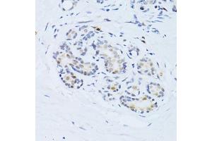 Immunohistochemistry of paraffin-embedded human breast using CDKN1A antibody (ABIN4903234) at dilution of 1:100 (40x lens). (p21 anticorps)