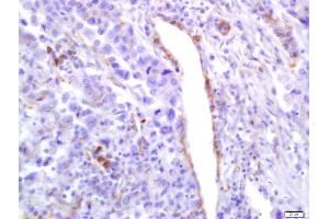 Formalin-fixed and paraffin embedded human lung carcinoma labeled with Anti-Phospho-PLK1 (Ser137) Polyclonal Antibody, Unconjugated (ABIN744938) at 1:200 followed by conjugation to the secondary antibody and DAB staining (PLK1 anticorps  (pSer137))
