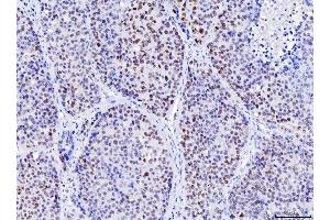 IHC analysis of MSH2 using anti-MSH2 antibody (ABIN7601369).
