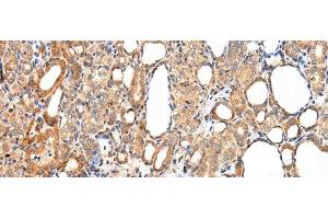 Immunohistochemistry of paraffin-embedded Human thyroid cancer tissue using AQP7 Polyclonal Antibody at dilution 1:40 (Aquaporin 7 anticorps)
