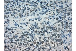 Immunohistochemical staining of paraffin-embedded Carcinoma of thyroid tissue using anti-STAT1mouse monoclonal antibody. (STAT1 anticorps)