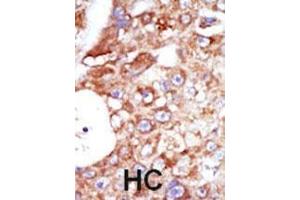 Formalin-fixed and paraffin-embedded human cancer tissue reacted with the primary antibody, which was peroxidase-conjugated to the secondary antibody, followed by AEC staining.