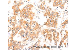 Immunohistochemistry of Human breast cancer using PRDX2 Polyclonal Antibody at dilution of 1:80 (Peroxiredoxin 2 anticorps)