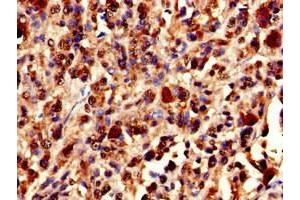 Immunohistochemistry of paraffin-embedded human melanoma using ABIN7175897 at dilution of 1:100 (XRCC5 anticorps  (AA 251-455))