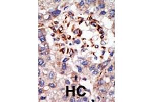 Formalin-fixed and paraffin-embedded human cancer tissue reacted with the primary antibody, which was peroxidase-conjugated to the secondary antibody, followed by DAB staining.