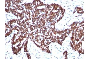 Formalin-fixed, paraffin-embedded human Ovarian Carcinoma stained with Cyclin B1 Mouse Monoclonal Antibody (CCNB1/1098). (Cyclin B1 anticorps)