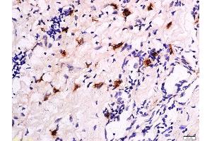 Formalin-fixed and paraffin embedded human colon carcinoma labeled with Anti-Beta-Catenin (Ser33 + 37) Polyclonal Antibody, Unconjugated  at 1:200 followed by conjugation to the secondary antibody and DAB staining.