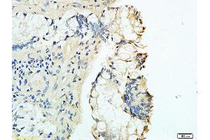 Formalin-fixed and human rectal carcinoma tissue labeled with Anti-B7-H1/PD-L1/CD274 Polyclonal Antibody, Unconjugated (ABIN737706) at 1:200 followed by conjugation to the secondary antibody and DAB staining