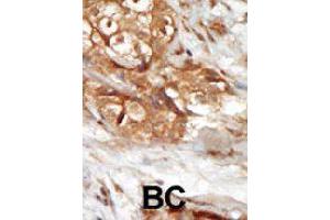 Formalin-fixed and paraffin-embedded human cancer tissue reacted with MAP3K14 polyclonal antibody  , which was peroxidase-conjugated to the secondary antibody, followed by AEC staining. (MAP3K14 anticorps  (AA 126-155))