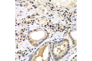 Immunohistochemistry of paraffin-embedded human gastric cancer using PSME2 antibody. (PSME2 anticorps  (AA 1-239))
