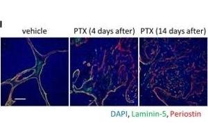 Dynamic regulation of mesenchymal cell expansion and tumor invasion in residual tumors upon chemotherapy.
