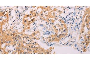 Immunohistochemistry of paraffin-embedded Human lung cancer tissue using ADHFE1 Polyclonal Antibody at dilution 1:30 (ADHFE1 anticorps)